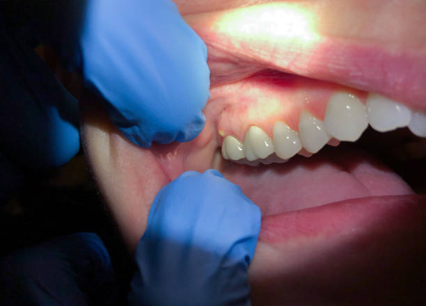 Best Cracked Tooth Emergency Dentist  in Samsula Spruce Creek, FL